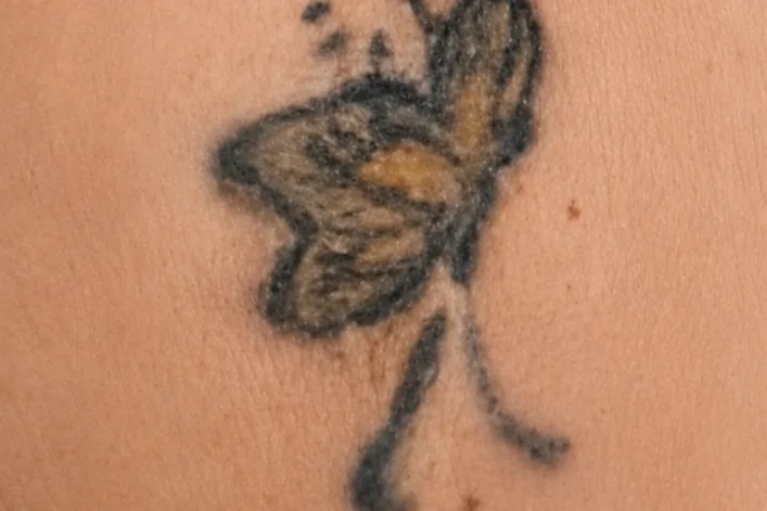 Antes da remoção de tatuagem