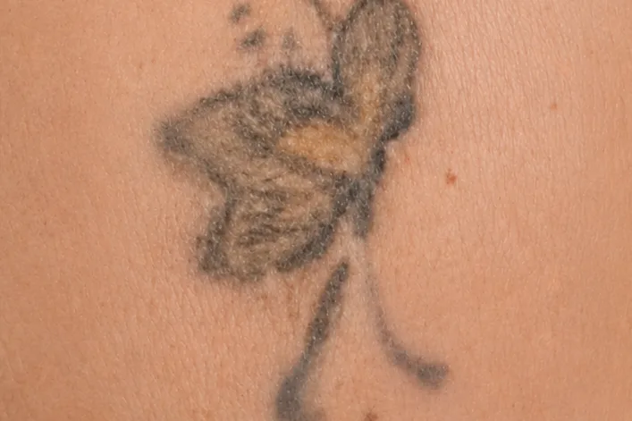 Depois da remoção de tatuagem, 1ª sessão