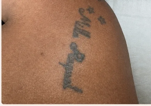 Antes da remoção de tatuagem