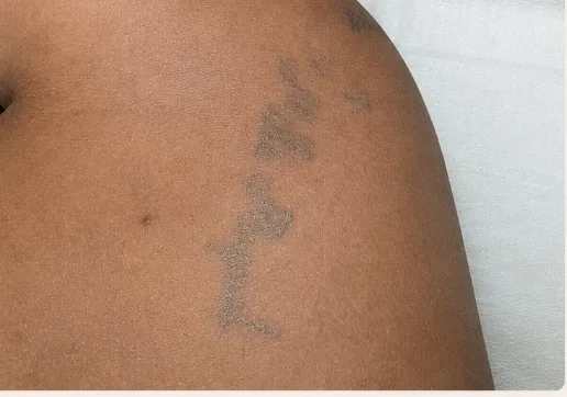 Depois da remoção de tatuagem, 1ª sessão